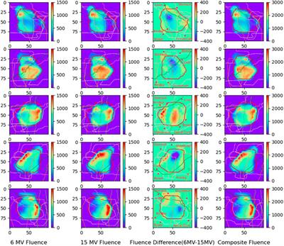 Continuous photon energy modulation in IMRT of pancreatic cancer